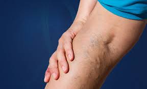 krčne žile na nogah